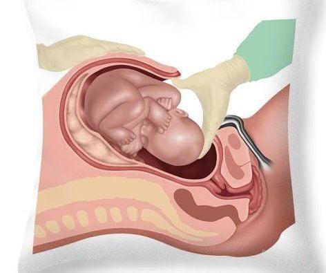 Giấc mơ mổ bụng tỉnh táo