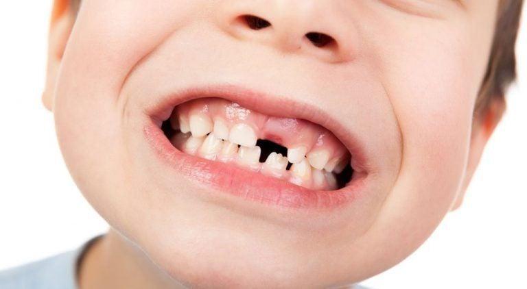 Răng mọc lại lệch sau khi rụng